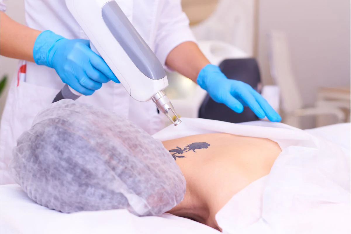 Preparing for Your Laser Tattoo Removal Session